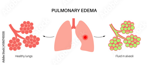 Pulmonary edema disease