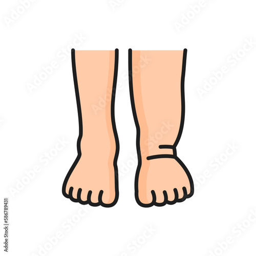 Foot disease and trauma injury of foot, allergic reaction color line icon. Vector lymphedema, swelling legs and edema allergic reaction