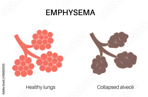 Emphysema anatomical poster