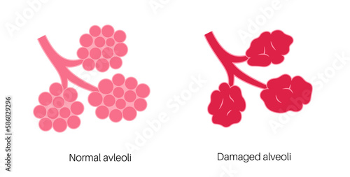 Emphysema anatomical poster