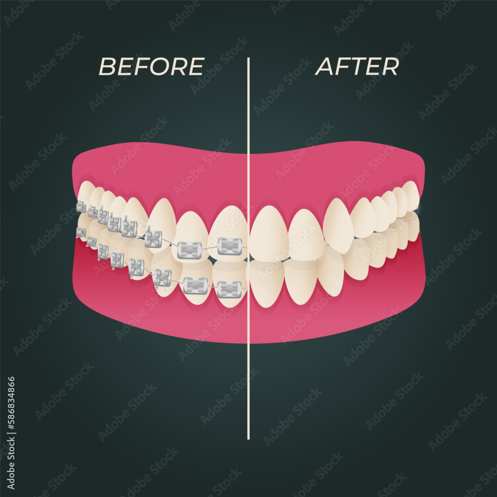 The concept of teeth alignment with braces. Orthodontic dentistry. The
