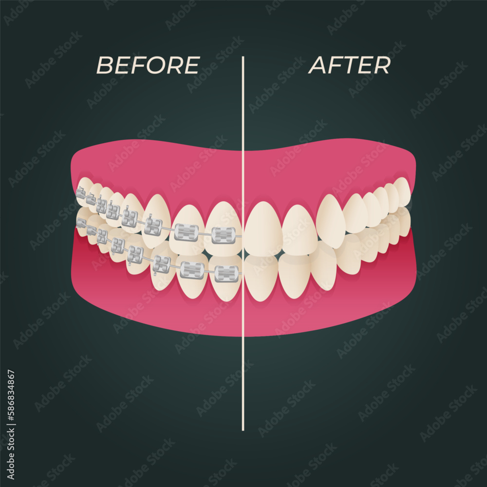 The concept of teeth alignment with braces. Orthodontic dentistry. The