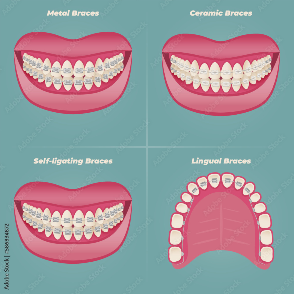 The concept of teeth alignment with braces. Orthodontic dentistry. The