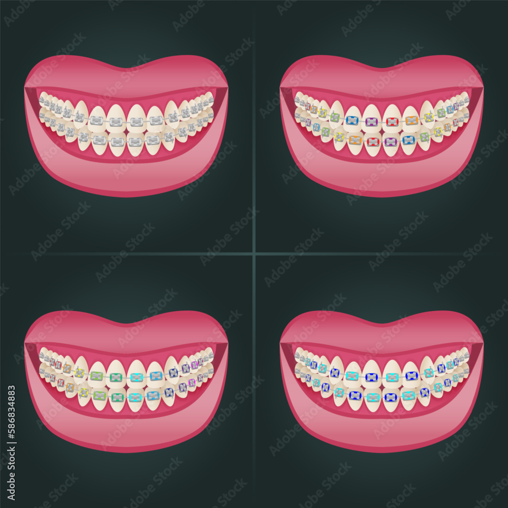 The concept of teeth alignment with braces. Orthodontic dentistry. The