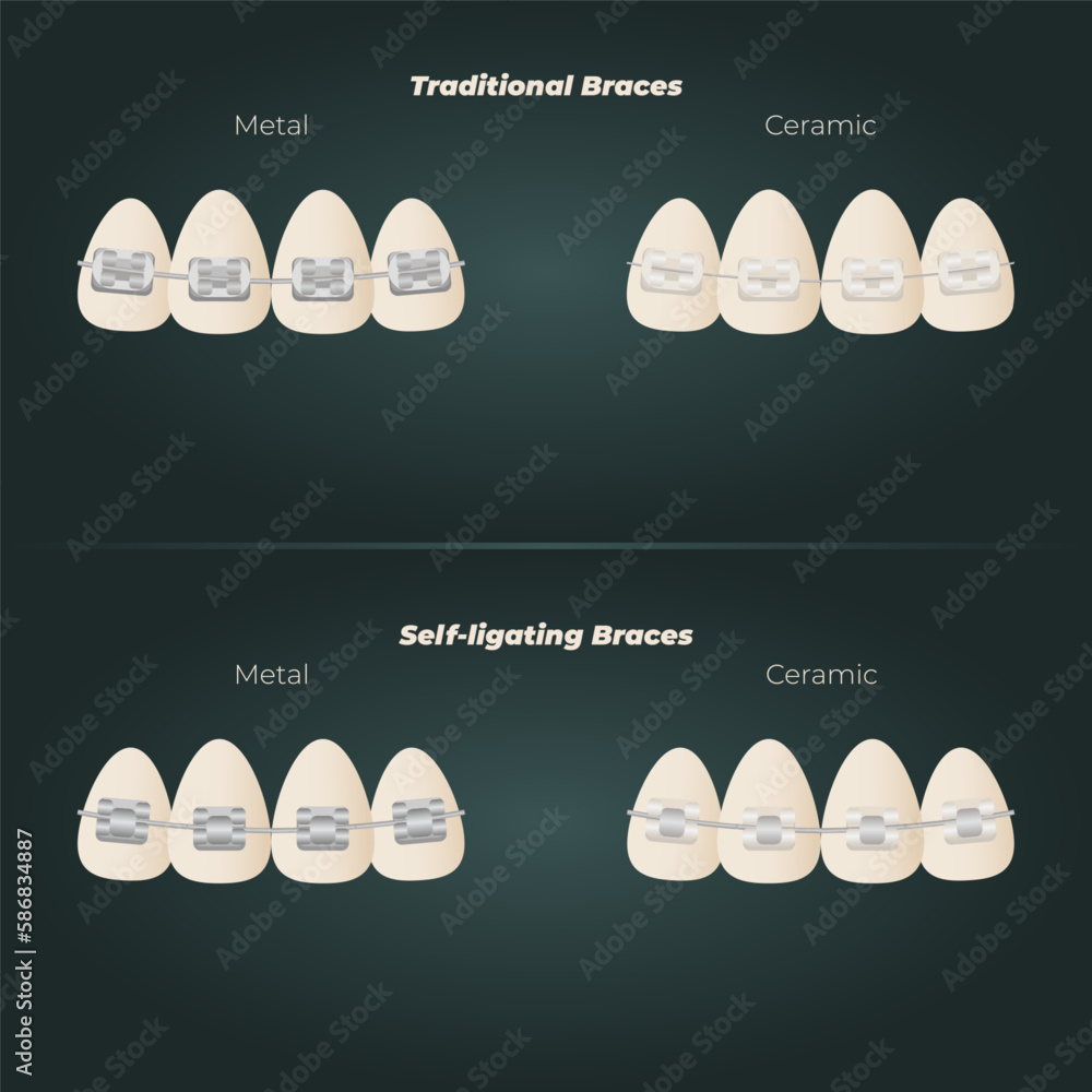 The concept of teeth alignment with braces. Orthodontic dentistry. The