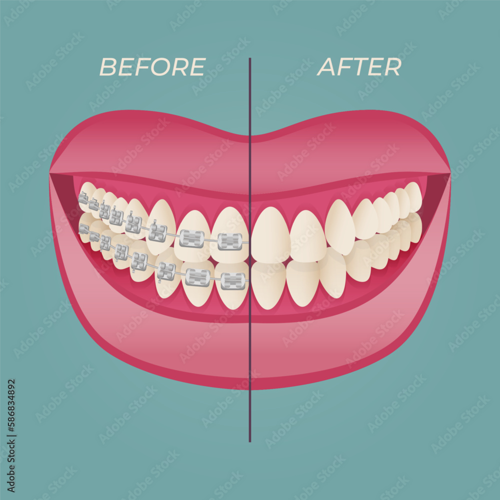 The concept of teeth alignment with braces. Orthodontic dentistry. The alignment of the teeth. Beautiful white teeth. Isolated flat vector illustration. Simple teeth in a row. Orthodontic treatment. The concept of teeth alignment with braces. Orthodontic dentistry. The alignment of the teeth. Beautiful white teeth. Isolated flat vector illustration. Simple teeth in a row. Orthodontic treatment.
