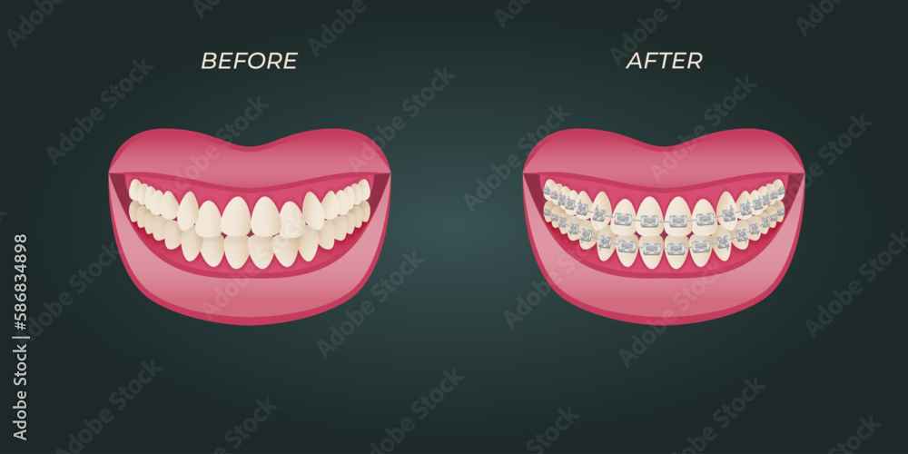 The concept of teeth alignment with braces. Orthodontic dentistry. The alignment of the teeth. Beautiful white teeth. Isolated flat vector illustration. Simple teeth in a row. Orthodontic treatment. The concept of teeth alignment with braces. Orthodontic dentistry. The alignment of the teeth. Beautiful white teeth. Isolated flat vector illustration. Simple teeth in a row. Orthodontic treatment.