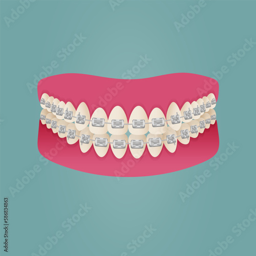 The concept of teeth alignment with braces. Orthodontic dentistry. The alignment of the teeth. Beautiful white teeth. Isolated flat vector illustration. Simple teeth in a row. Orthodontic treatment.