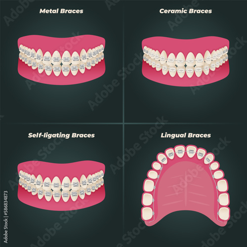 The concept of teeth alignment with braces. Orthodontic dentistry. The alignment of the teeth. Beautiful white teeth. Isolated flat vector illustration. Simple teeth in a row. Orthodontic treatment.