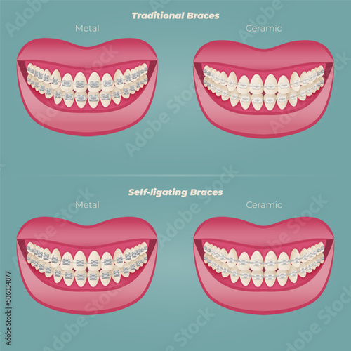 The concept of teeth alignment with braces. Orthodontic dentistry. The alignment of the teeth. Beautiful white teeth. Isolated flat vector illustration. Simple teeth in a row. Orthodontic treatment.