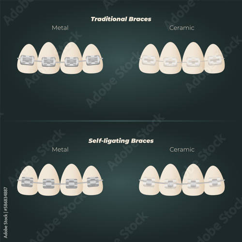 The concept of teeth alignment with braces. Orthodontic dentistry. The alignment of the teeth. Beautiful white teeth. Isolated flat vector illustration. Simple teeth in a row. Orthodontic treatment.