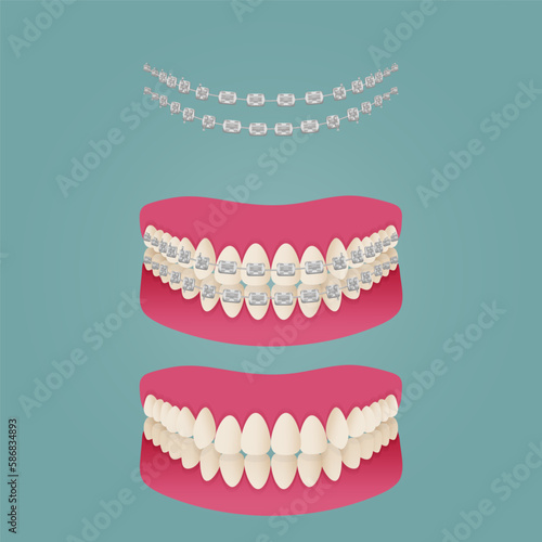 The concept of teeth alignment with braces. Orthodontic dentistry. The alignment of the teeth. Beautiful white teeth. Isolated flat vector illustration. Simple teeth in a row. Orthodontic treatment.