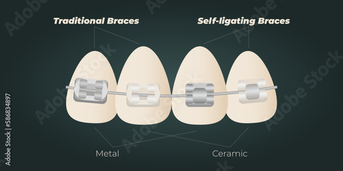 The concept of teeth alignment with braces. Orthodontic dentistry. The alignment of the teeth. Beautiful white teeth. Isolated flat vector illustration. Simple teeth in a row. Orthodontic treatment.