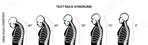 Neck vertebrae deformity