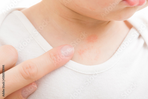 Wallpaper Mural Young adult mother finger pointing to red rash on infant breast. Baby boy isolated on light gray background. Allergy from food, milk formula or mother milk. Skin problem. Closeup. Torontodigital.ca