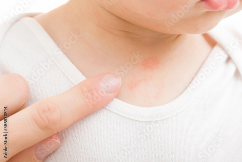 Young adult mother finger pointing to red rash on infant breast. Baby boy isolated on light gray background. Allergy from food, milk formula or mother milk. Skin problem. Closeup.