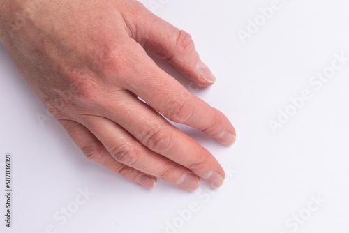 Close-up of female age-related hands with natural broken unhealthy diseased nails  overgrown cuticle