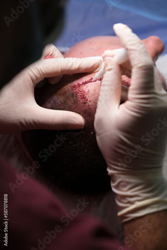 Hair transplant treatment in the operating room. photo