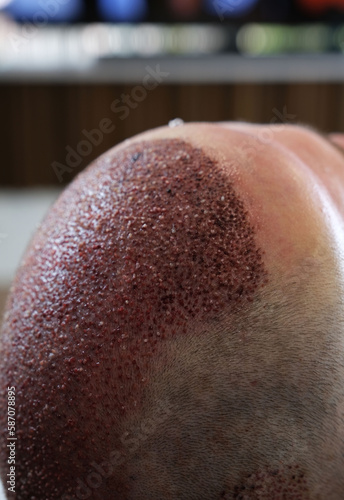 Close up after hair transplant operation. photo