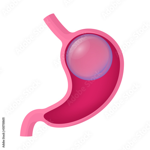 Gastric balloon weight loss. Installation of a gastric balloon into stomach. Methods of weight loss surgery. Human anatomy. Vector illustration.