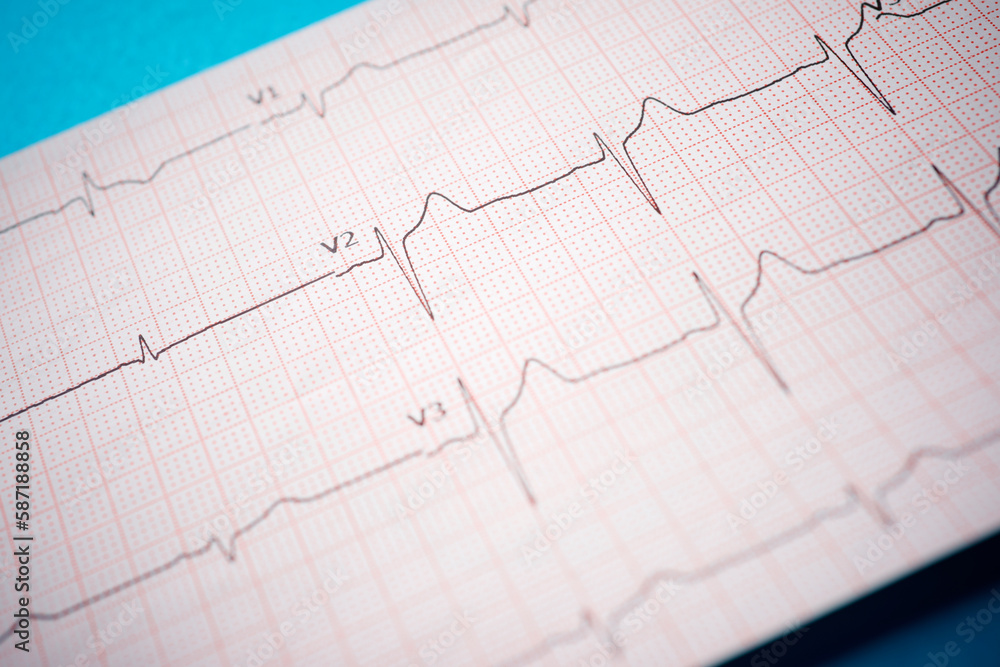 Electrocardiogram printed on paper on a blue table. Electrocardiogram printed on paper on a blue table.