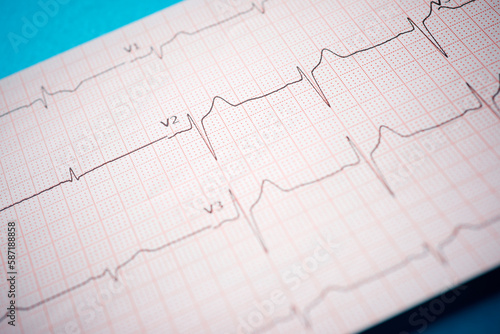 Electrocardiogram printed on paper on a blue table.