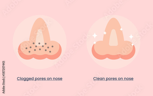 Clogged pores and clean pores on nose. hygiene concept. vector illustration.