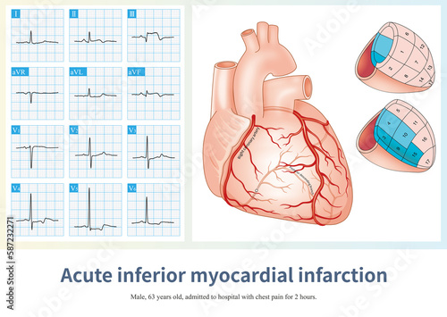 When the RCA is occluded, it can cause acute inferior myocardial infarction, and the amplitude of ST segment elevation in lead II is usually greater than that in lead III.