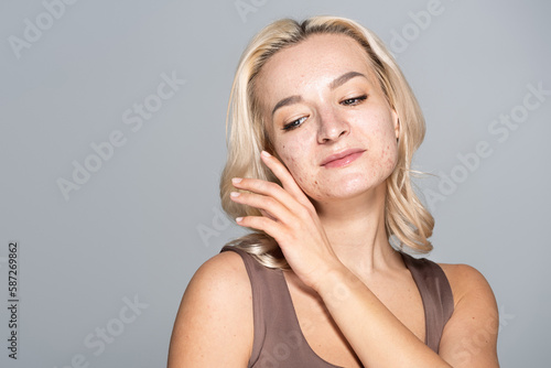 Pretty blonde woman with problem skin touching cheek isolated on grey.