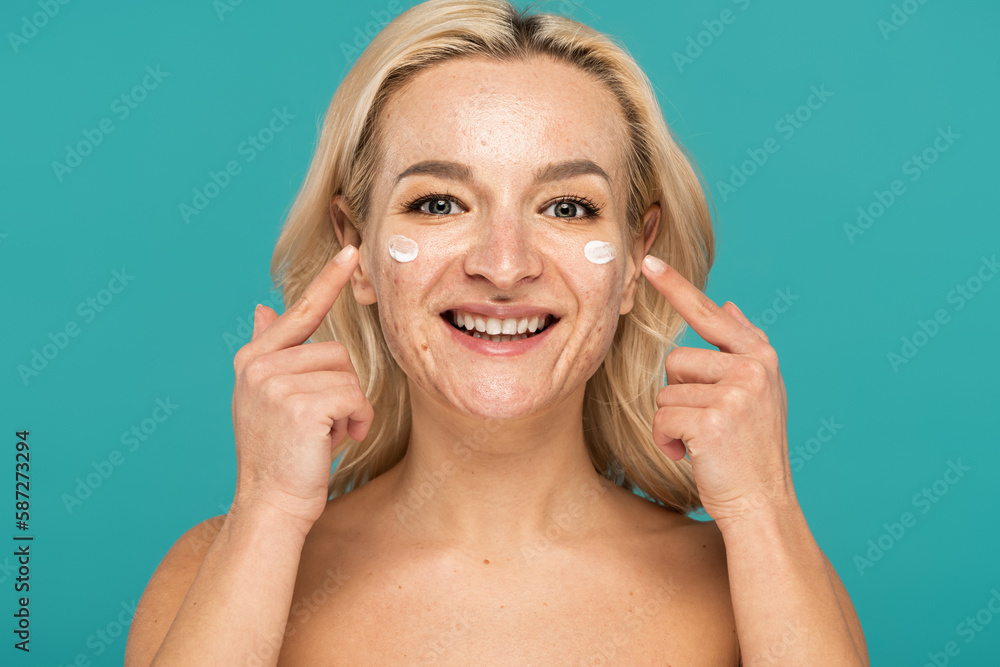 cheerful woman with acne applying cream and pointing with fingers at face isolated on turquoise. cheerful woman with acne applying cream and pointing with fingers at face isolated on turquoise.