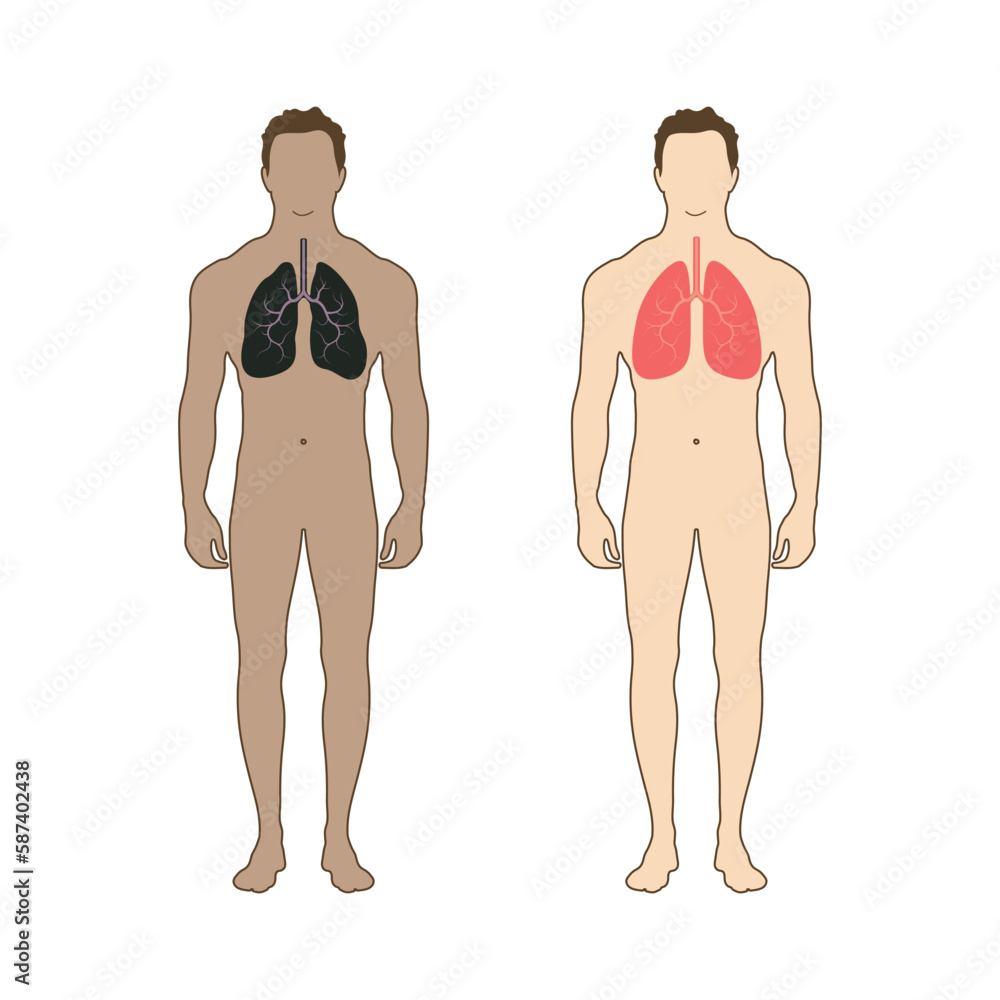 A person with healthy lungs and sick lungs. Flat style. A person with healthy lungs and sick lungs. Flat style.