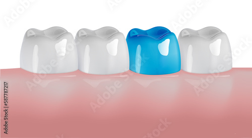 Molar teeth implant, bridge or veneer treatment for missing tooth surgery restoration. Artificial prosthesis or oral crown as row gap filling.