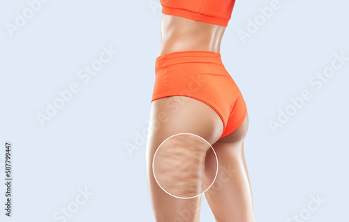 A woman in orange underwear with cellulite on her legs. Obese woman. Overweight treatment. Photo before and after weight loss.