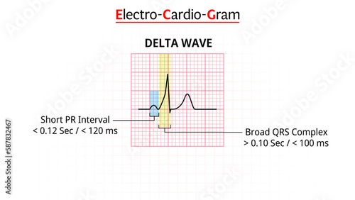 Delta Wave - ECG Morphology - Electrocardiogram - Vector Illustration
