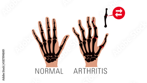 Arthritis illustration