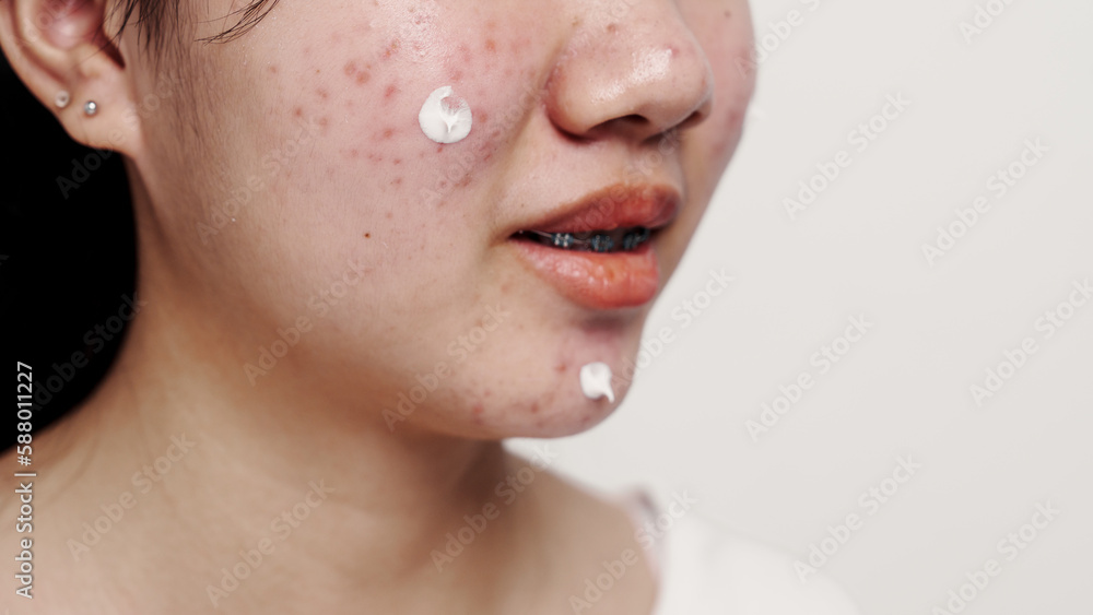 Asian teenage with acne face skin problem, Dermatological disease, white background. Asian teenage with acne face skin problem, Dermatological disease, white background.