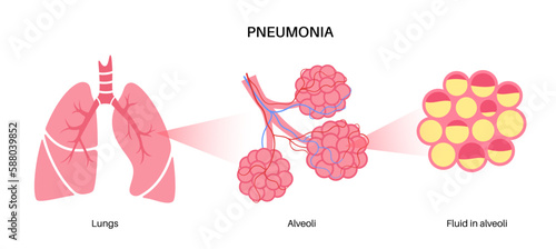 Pneumonia infection poster
