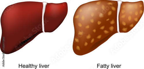 fatty liver disease. Healthy liver and hepatic steatosis. photo