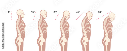 Neck vertebrae deformity