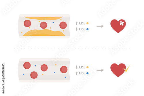 Efectos del colesterol bueno y malo, HDL y LDL, salud del corazón. Infografía vasos sanguíneos., placa de colesterol, eritrocitos, arterias, flujo sanguíneo, salud cardiovascular riesgo cardiovascular