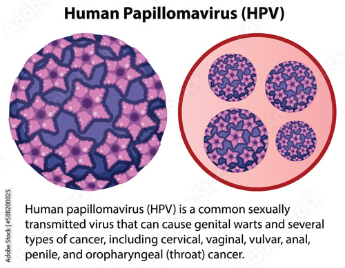 Human Papillomavirus with explanation