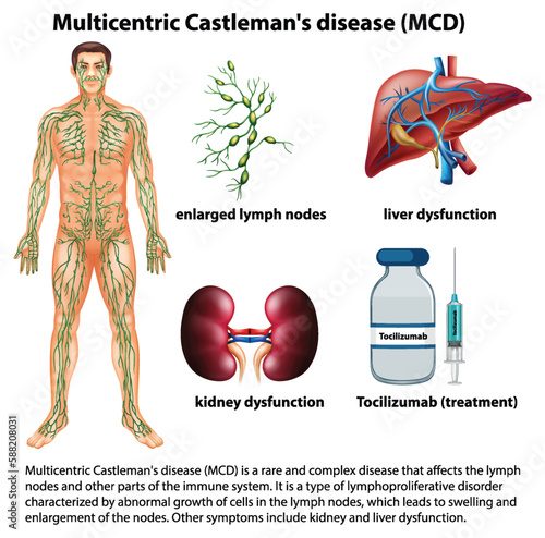 Multicentric Castlemans Disease (MCD) Infographic