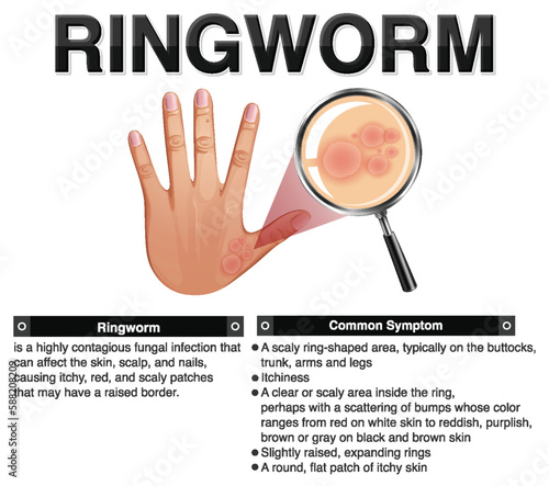 Informative symptoms of Ringworm