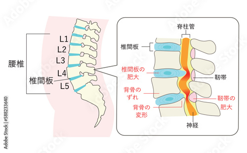 脊柱管狭窄症になった腰椎の説明イラスト拡大図