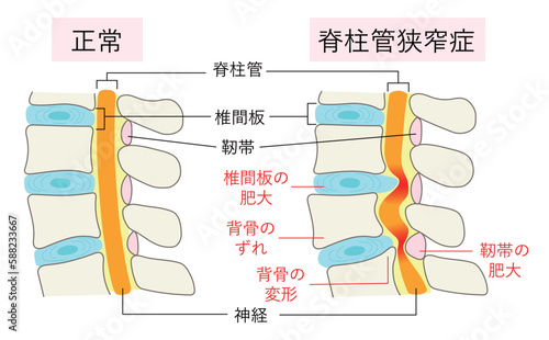 正常な腰椎と脊柱管狭窄症の比較イラスト