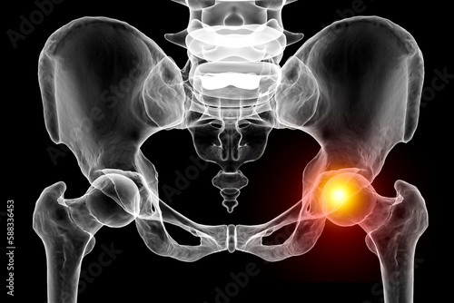 Hip joint pain, conceptual 3D illustration photo