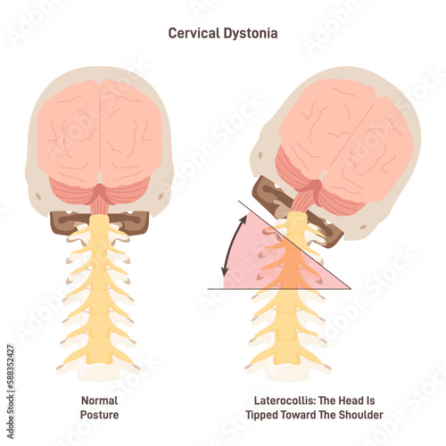 Cervical dystonia. Spasmodic torticollis, inflamatory condition when neck photo
