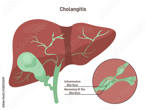 Cholangitis or ascending cholangitis. Infection and imflamation photo