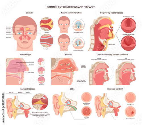 Common ENT diseases set. Nose, throat and ears bacterial infections