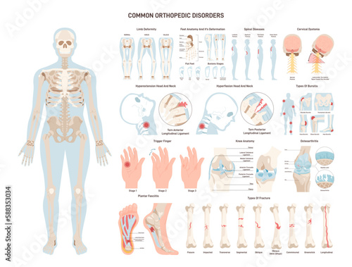 Orthopedic diseases set. Human skeleton, ligament and joints injuries